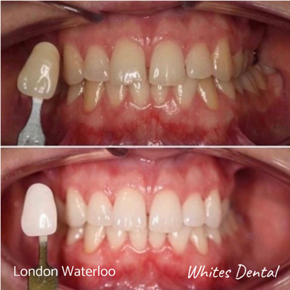Instant Laser Zoom Teeth Whitening in London Waterloo. Whites Dental