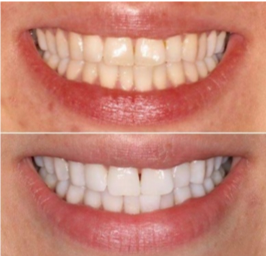 Instant Laser Zoom Teeth Whitening in London Waterloo | Whites Dental