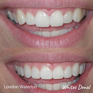 Porcelain veneers in London Waterloo | Whites Dental
