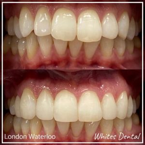 Composite Bonding Before And After Picture 10