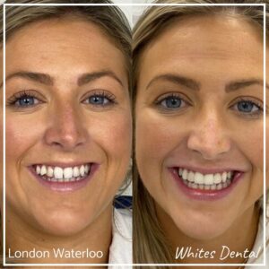 Composite Bonding Before And After Picture 11