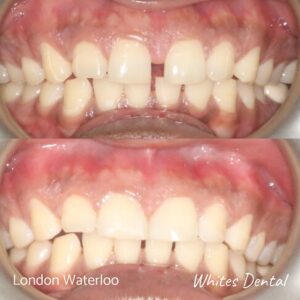 Composite Bonding Before And After Picture 12