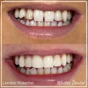 Composite Bonding Before And After Picture 13