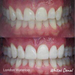 Composite Bonding Before And After Picture 14