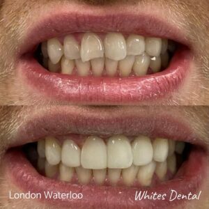 Composite Bonding Before And After Picture 15