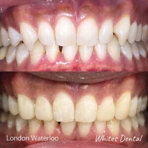 Composite Bonding Before And After Picture 18