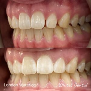 Composite Bonding Before And After Picture 7