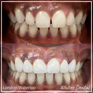 Composite Bonding Before And After Picture 8