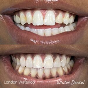 Composite Bonding Before And After Picture 9