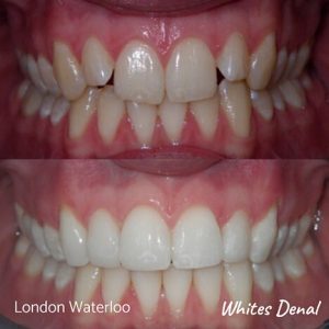 Invisalign Braces Before And After 10