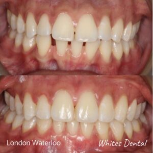 Invisalign Braces Before And After 13