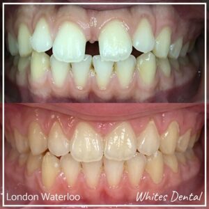 Invisalign Braces Before And After 15