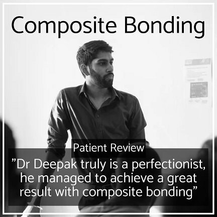 Composite Bonding Whites Dental in London Waterloo 1