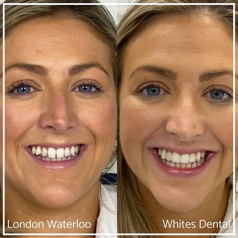 Composite Bonding Before And After - Cosmetic Dentist in London 1