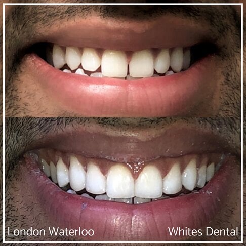 Composite Bonding Before And After Cosmetic Dentist in London 10 | Whites Dental