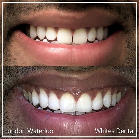 Close-up photos of a smile before and after composite bonding.