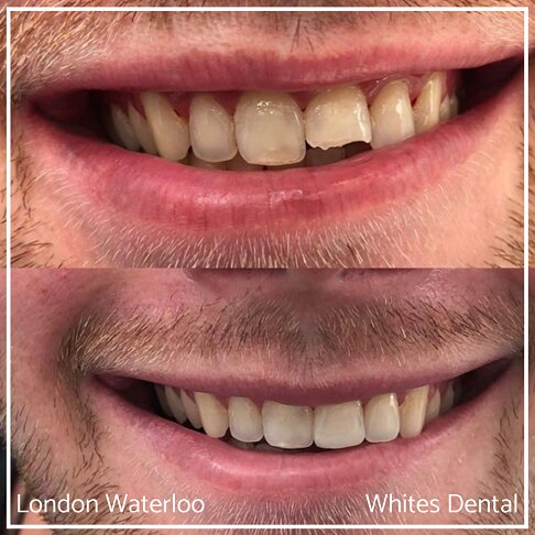 Composite Bonding Before And After Cosmetic Dentist in London 11 | Whites Dental