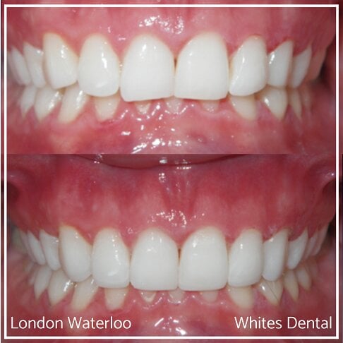 Composite Bonding Before And After - Cosmetic Dentist in London 12