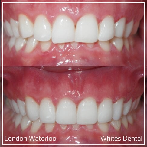 Close-up comparison of teeth showing composite bonding results.