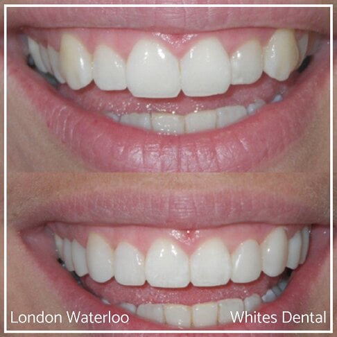 Composite Bonding Before And After Cosmetic Dentist in London 13 | Whites Dental