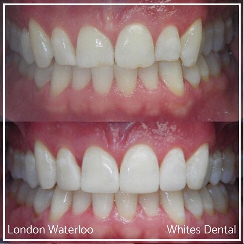 Composite Bonding Before And After - Cosmetic Dentist in London 14