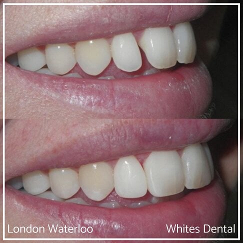 Composite Bonding Before And After Cosmetic Dentist in London 15 | Whites Dental