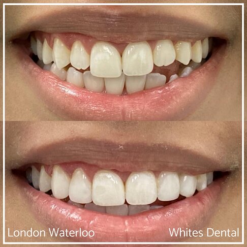 Composite Bonding Before And After Cosmetic Dentist in London 16 | Whites Dental