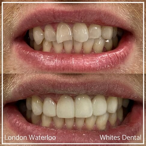 Composite Bonding Before And After Cosmetic Dentist in London 17 | Whites Dental
