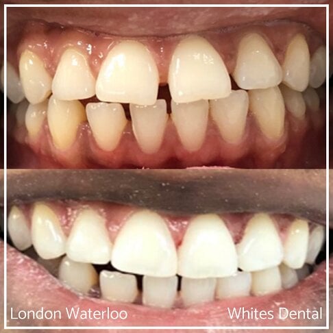 Composite Bonding Before And After - Cosmetic Dentist in London 19