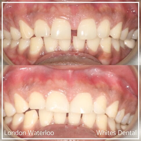 Composite Bonding Before And After Cosmetic Dentist in London 20 | Whites Dental