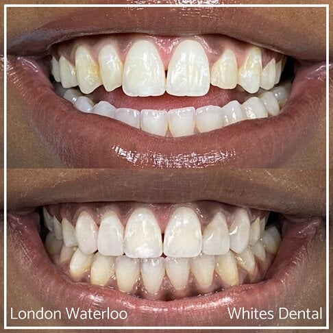 Composite Bonding Before And After Cosmetic Dentist in London 21 | Whites Dental