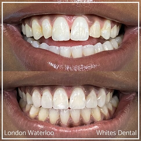 Close-up images of teeth showing composite bonding improvement.