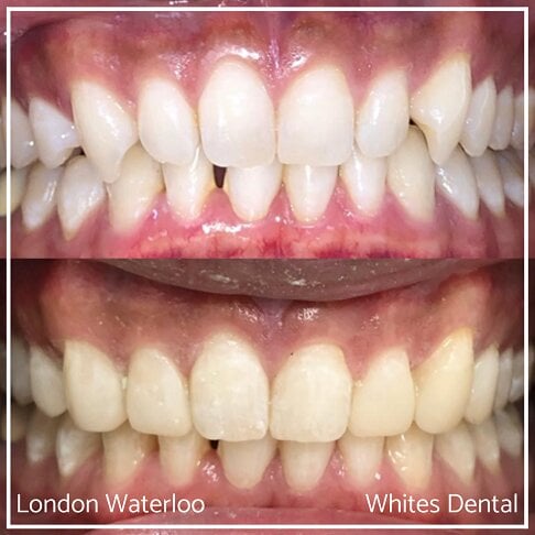 Composite Bonding Before And After Cosmetic Dentist in London 22 | Whites Dental