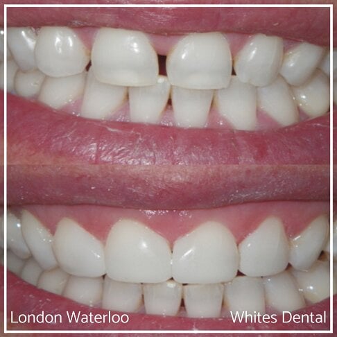 Composite Bonding Before And After Cosmetic Dentist in London 23 | Whites Dental