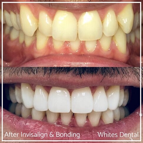 Composite Bonding Before And After - Cosmetic Dentist in London 24