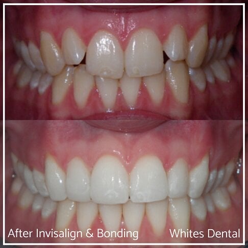 Composite Bonding Before And After - Cosmetic Dentist in London 26