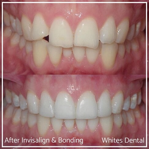 Composite Bonding Before And After Cosmetic Dentist in London 27 | Whites Dental