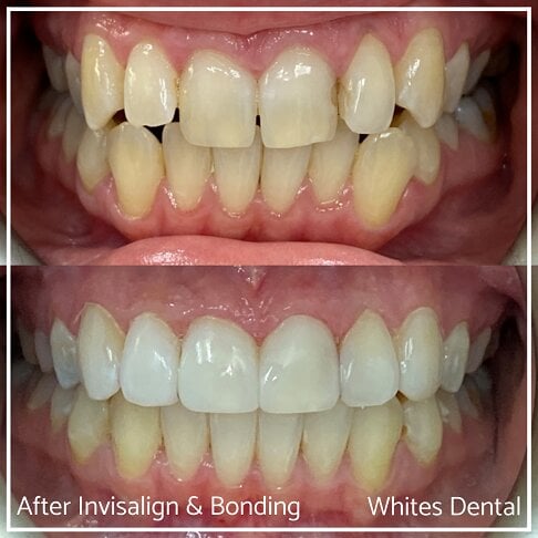 Composite Bonding Before And After - Cosmetic Dentist in London 28