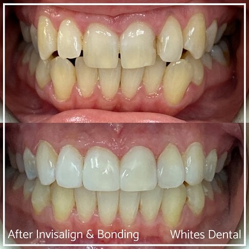 Close-up of mouth before and after Invisalign and composite bonding.