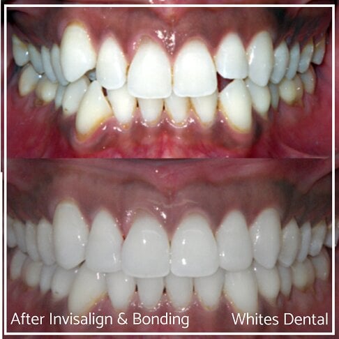 Composite Bonding Before And After Cosmetic Dentist in London 29 | Whites Dental