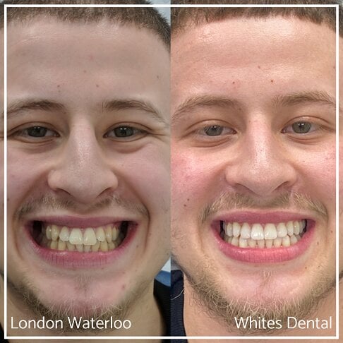 Composite Bonding Before And After Cosmetic Dentist in London 3 | Whites Dental