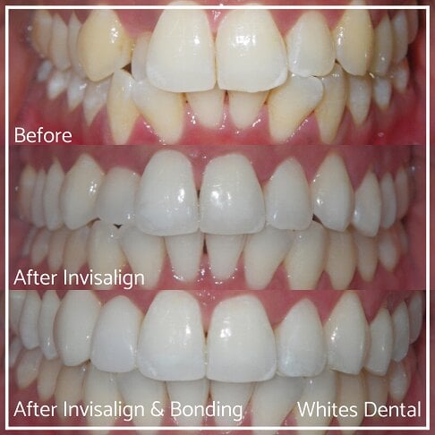 Composite Bonding Before And After Cosmetic Dentist in London 30 | Whites Dental