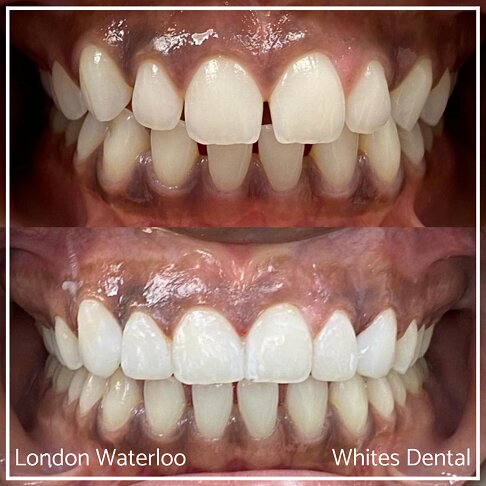 Composite Bonding Before And After Cosmetic Dentist in London 4 | Whites Dental
