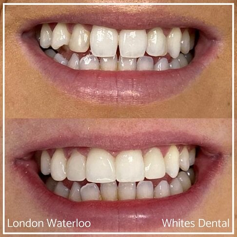 Composite Bonding Before And After - Cosmetic Dentist in London 5