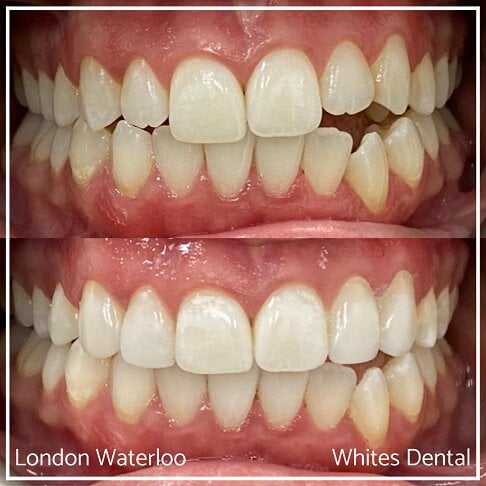 Composite Bonding Before And After Cosmetic Dentist in London 6 | Whites Dental
