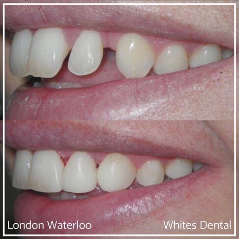 Composite Bonding Before And After Cosmetic Dentist in London 7 | Whites Dental