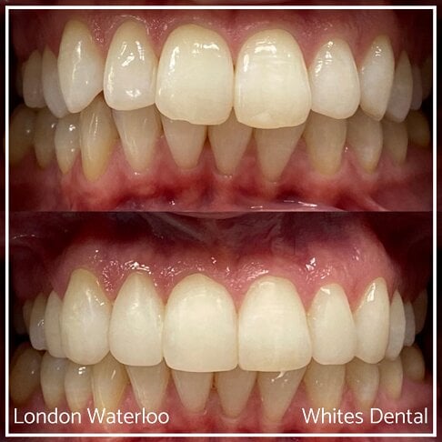 Composite Bonding Before And After Cosmetic Dentist in London 8 | Whites Dental