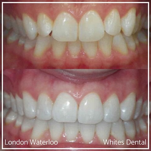 Composite Bonding Before And After Cosmetic Dentist in London 9 | Whites Dental