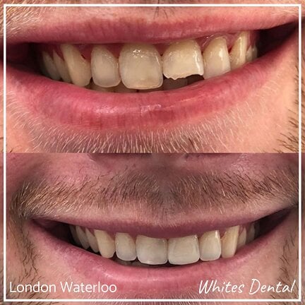 Composite Bonding London Waterloo 1 | Whites Dental