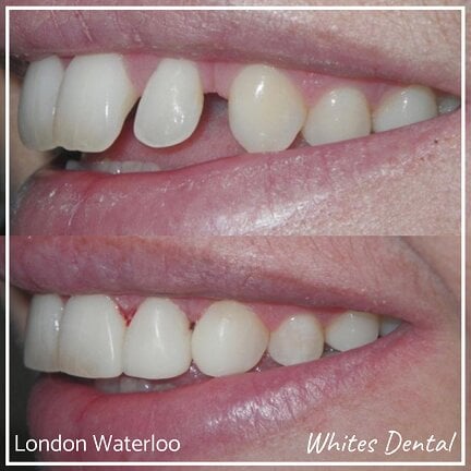 Composite Bonding London Waterloo 2 | Whites Dental